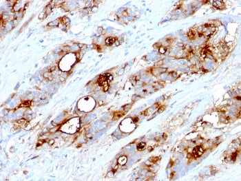 IHC testing of FFPE human colon carcinoma stained with CEA antibody (clone CEA31).