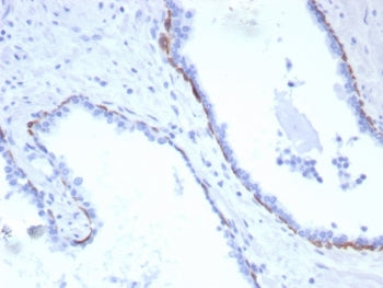 IHC staining of FFPE human prostate carcinoma tissue with recombinant Cytokeratin 17 antibody (clone