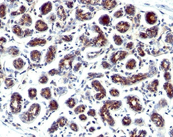 IHC staining of human breast cancer with Estrogen Inducible Protein pS2 antibody.