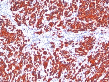 IHC staining of FFPE human breast carcinoma tissue with Pan Cytokeratin antibody cocktail (clone SPM