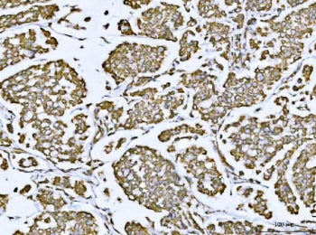 IHC staining of FFPE human breast cancer tissue with VDAC1 antibody. HIER: boil tissue sections in p