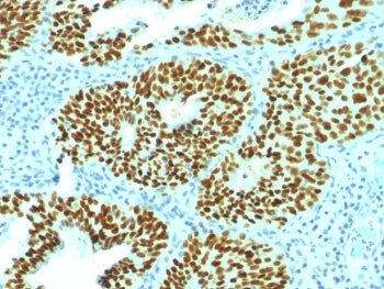 IHC testing of FFPE human cervical carcinoma with SOX2 antibody (clone SOX2/1792). Required HIER: bo