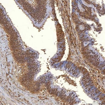 IHC staining of FFPE human colon adenocarcinoma tissue with PIG3 antibody. HIER: boil tissue section