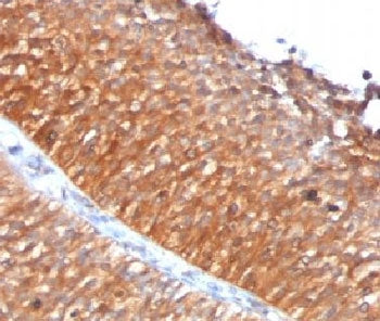 IHC testing of FFPE human bladder carcinoma with Mitochondrial antibody (clone MTC719).