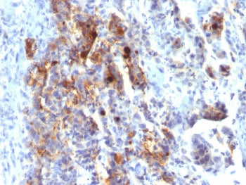 IHC staining of FFPE human gastric carcinoma with biotinylated MUC5AC antibody (clone 45M1). HIER: b
