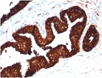 IHC staining of FFPE human prostate carcinoma tissue with recombinant PSA antibody (clone KLK3/4602R