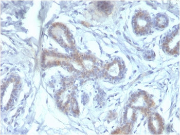 IHC staining of FFPE human breast carcinoma with BAP1 antibody. HIER: boil tissue sections in pH 9 1