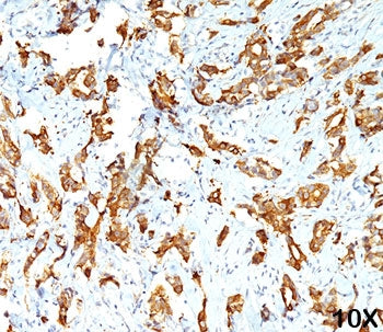 IHC testing of FFPE human breast carcinoma (10X) stained with HSP27 antibody (clone G3.1).