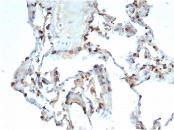 IHC staining of FFPE human lung carcinoma tissue with SFTPD (clone SFTPD/7086R). HIER: boil tissue s