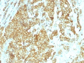 IHC: Formalin-fixed, paraffin-embedded human breast carcinoma stained with GRP94 antibody (clone HSP