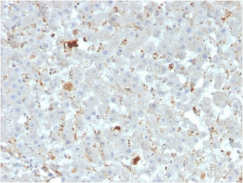 IHC staining of FFPE human liver carcinoma with APOAIV antibody. HIER: boil tissue sections in pH 9 