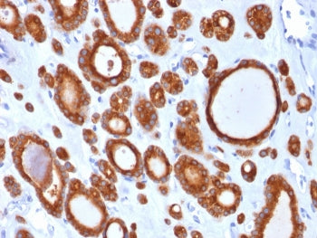 IHC staining of FFPE human thyroid carcinoma with TPO antibody (clone TPO/1921). HIER: boil tissue s