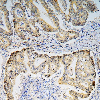 IHC staining of FFPE human rectal cancer with BRG1 antibody. HIER: boil tissue sections in pH6, 10mM
