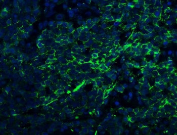 Immunofluorescent staining of FFPE human lung cancer with Claudin 1 antibody (green) and DAPI nuclea
