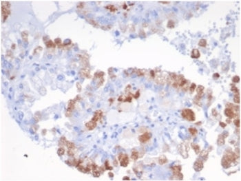 IHC staining of FFPE human renal carcinoma tissue with SREBF2 antibody (clone SREBP2/1580) at 2ug/ml