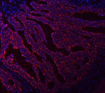 Immunofluorescent staining of FFPE human intestinal cancer tissue with ASNS antibody (red) and DAPI 