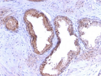 IHC staining of FFPE human prostate carcinoma with PSA antibody (clone KLK3/2871R). HIER: boil tissu