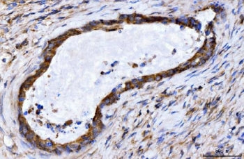 IHC staining of FFPE human gall bladder adenosquamous carcinoma tissue with GIGYF2 antibody. HIER: b