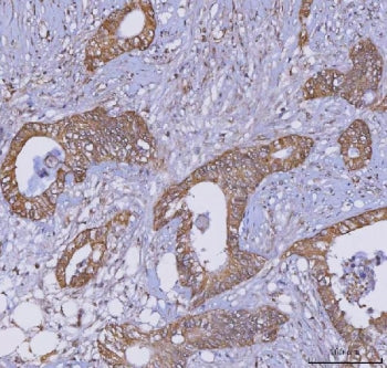 IHC staining of FFPE human colorectal adenocarcinoma tissue with TRIM16 antibody. HIER: boil tissue 