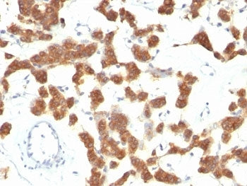 IHC analysis of formalin-fixed, paraffin-embedded human thyroid carcinoma stained with CK18 antibody