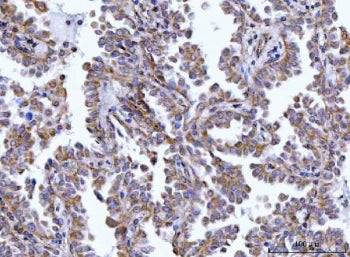 IHC staining of FFPE human lung cancer tissue with HAX1 antibody. HIER: boil tissue sections in pH8 