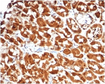 IHC staining of FFPE human colon carcinoma tissue with recombinant Interleukin 2 antibody (clone IL2