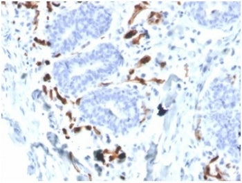 IHC staining of FFPE human breast carcinoma tissue with FABP4 antibody (clone FABP4/4426) at 2ug/ml 