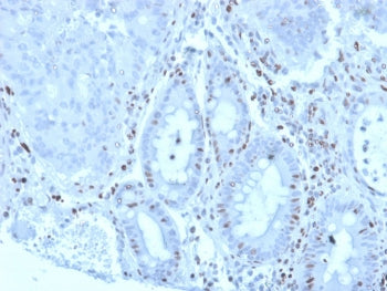 IHC staining of FFPE human colon carcinoma tissue with Myeloid zinc finger 1 antibody (clone PCRP-MZ