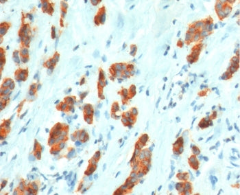 IHC testing of FFPE human breast carcinoma with recombinant MUC1 antibody (clone MCN01-2R). Required