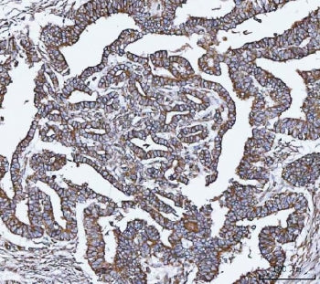 IHC staining of FFPE human cervical cancer tissue with VAPA antibody. HIER: boil tissue sections in 