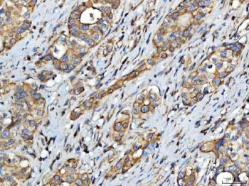 IHC staining of FFPE human colorectal adenocarcinoma tissue with FATP-4 antibody. HIER: boil tissue 