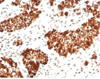 IHC staining of FFPE human ovarian carcinoma tissue with recombinant MSH6 antibody (clone MSH6/7065R