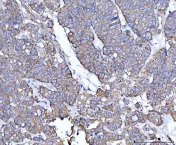 IHC staining of FFPE human ovarian cancer tissue with Tollip antibody. HIER: boil tissue sections in