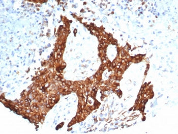 IHC staining of FFPE human ovarian carcinoma tissue with recombinant Tubulin Beta antibody (clone TU
