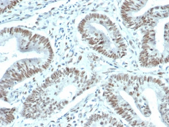 IHC staining of FFPE human prostate carcinoma tissue with recombinant FOXP1 antibody (clone FOXP1/44