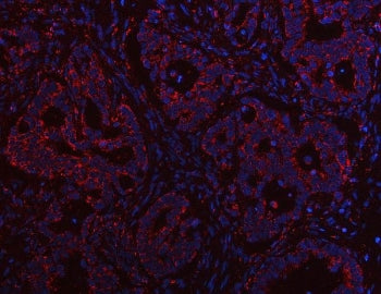 Immunofluorescent staining of FFPE human rectal cancer tissue with PTPIP51 antibody (red) and DAPI n