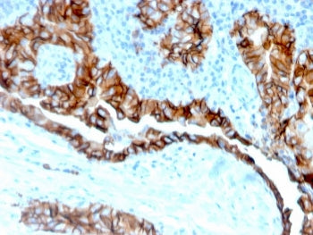 IHC staining of FFPE human thyroid carcinoma tissue with TACSTD2 antibody (clone TACSTD2/6394R). HIE