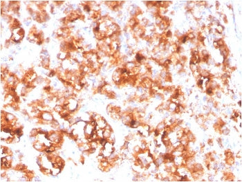 IHC staining of FFPE human prostate carcinoma with FOLH1 antibody. HIER: boil tissue sections in pH 