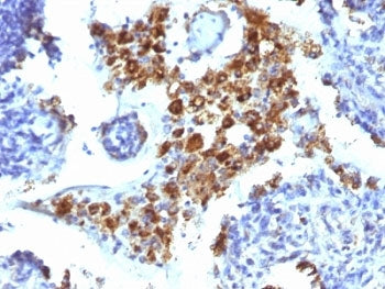 IHC: Formalin-fixed, paraffin-embedded human lung Adenocarcinoma stained with Napsin-A antibody (clo