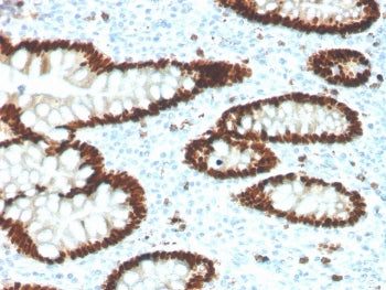 IHC staining of FFPE human colon carcinoma with recombinant CDX2 antibody. HIER: boil tissue section