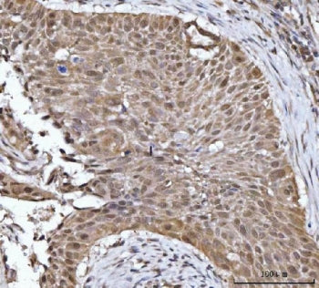 IHC staining of FFPE human esophageal squamous carcinoma tissue with YWHAG antibody. HIER: boil tiss
