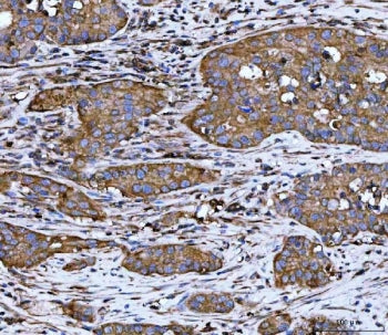 IHC staining of FFPE human colorectal adenocarcinoma tissue with WD repeat-containing protein 1 anti