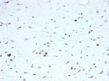 IHC staining of FFPE human rhabdomyosarcoma tissue with recombinant MyoD1 antibody (clone rMYOD1/691