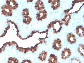 IHC staining of FFPE human breast carcinoma with recombinant pS2 antibody (clone rTFF1/1091). HIER: 