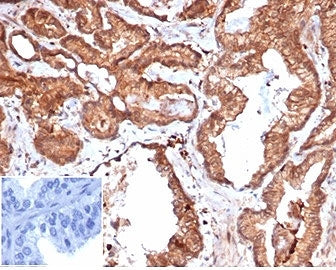 IHC staining of FFPE human prostate carcinoma tissue with recombinant Integrin Associated Protein an