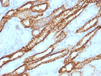 IHC testing of FFPE human renal cell carcinoma with Cadherin 16 antibody. Required HIER: steam secti