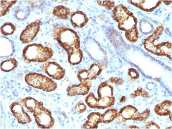 IHC staining of FFPE human renal cell carcinoma with recombinant AMACR antibody. HIER: boil tissue s