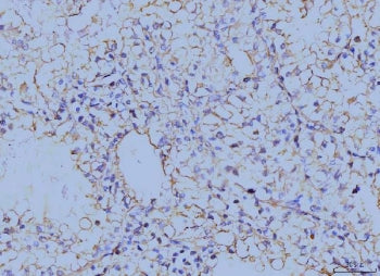 IHC staining of FFPE human renal clear cell carcinoma tissue with Annexin VI antibody. HIER: boil tissue sections in pH8 EDTA for 20 min and allow to cool before testing.