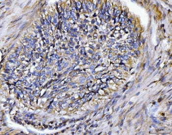 IHC staining of FFPE human lung cancer tissue with BIN1 antibody. HIER: boil tissue sections in pH8 