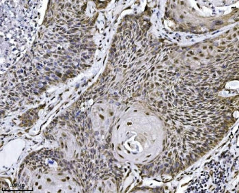 IHC staining of FFPE human squamous cell lung carcinoma tissue with NDFIP2 antibody. HIER: boil tiss